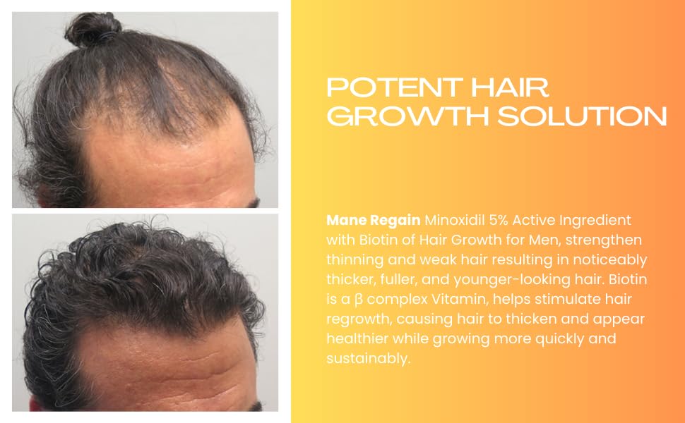 Minoxidil Topical Solution USP 5%, Extra Strength Hair Regrowth Treatment for Men, 2 Month Supply, Unscented, 4 Fl Oz (2 Pack)