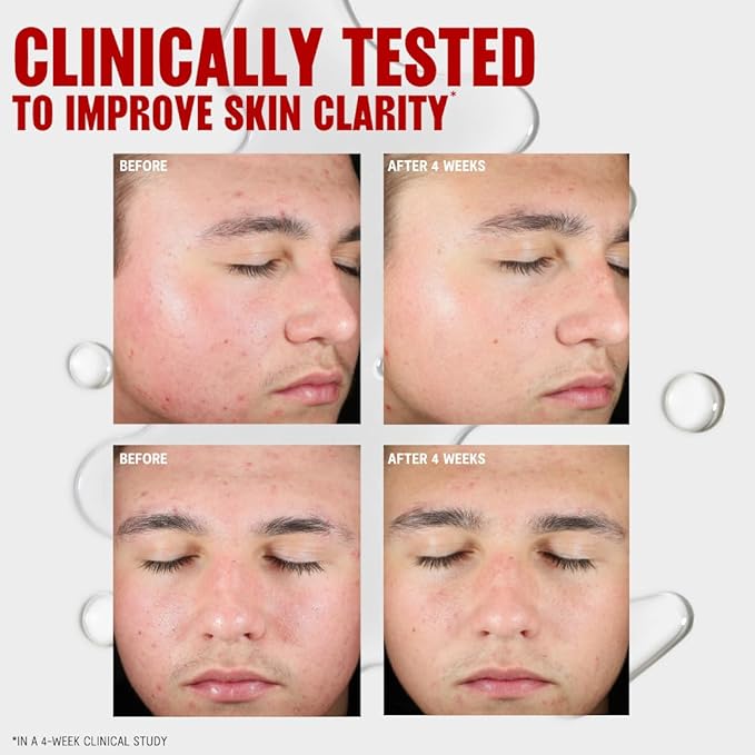 Thayers Blemish Clearing Salicylic Acid Toner, Acne Treatment Face Toner with 2% Salicylic Acid, Soothing and Non-Stripping Skin Care, 12 Fl Oz