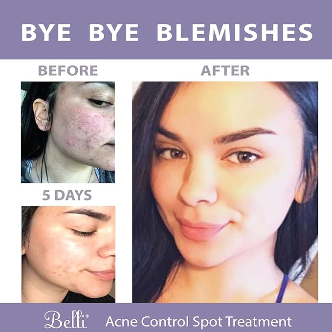 Belli Skincare Acne Control Spot Treatment - Skin Care Treatment - Acne Treatment - Vegan Face Wash - Pregnancy Acne Treatment - Acne Spot Treatment for Face - Face Care