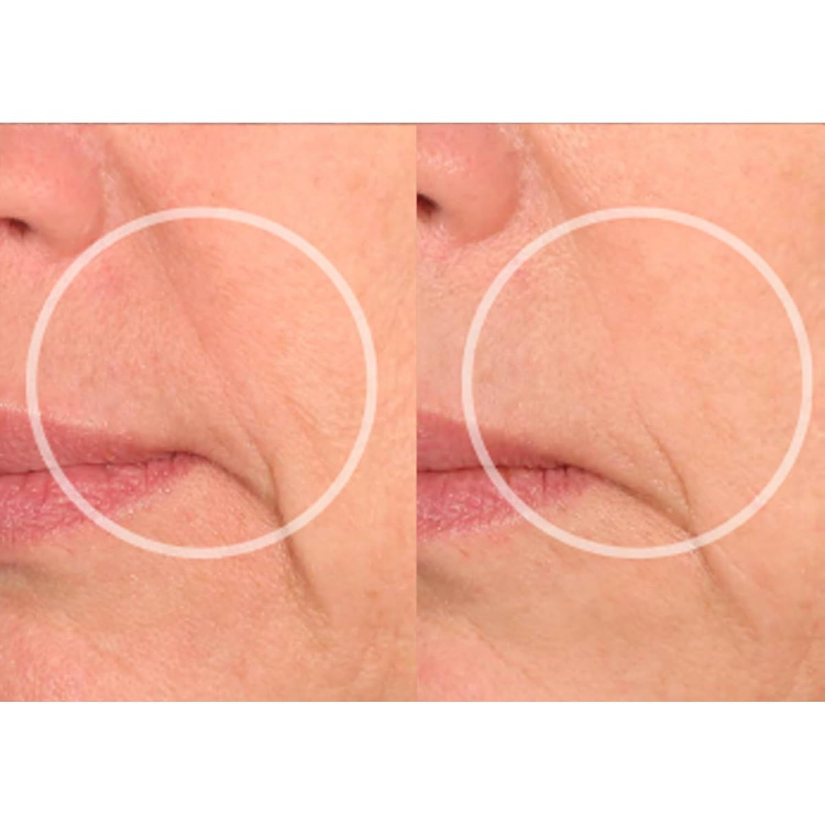 SiO Beauty Eye & Smile Lift - Eye & Smile Anti-Wrinkle Patches 2 Week Supply - Overnight Smoothing Silicone Patches for Wrinkles and Fine Lines