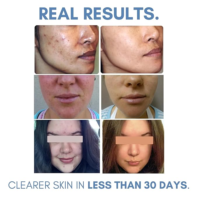 Clearogen Clarifying Toner for Acne and Blemishes, Face Toner, Facial Toner, Skin Toner, Acne Toner, Toner Oily Skin, Salicylic Acid Toner, Astringent for Face, Toners, 4 Fl Oz