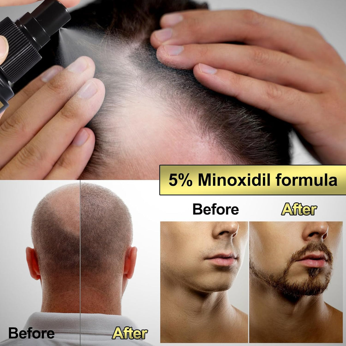 5% Minoxidil for Men Hair Growth Serum - Hair Regrowth Topical Spray Infused With Biotin - Thinning Hair and Anti Hair Loss Treatment Thicker Longer Fuller Healthier Hair 2 Month Supply